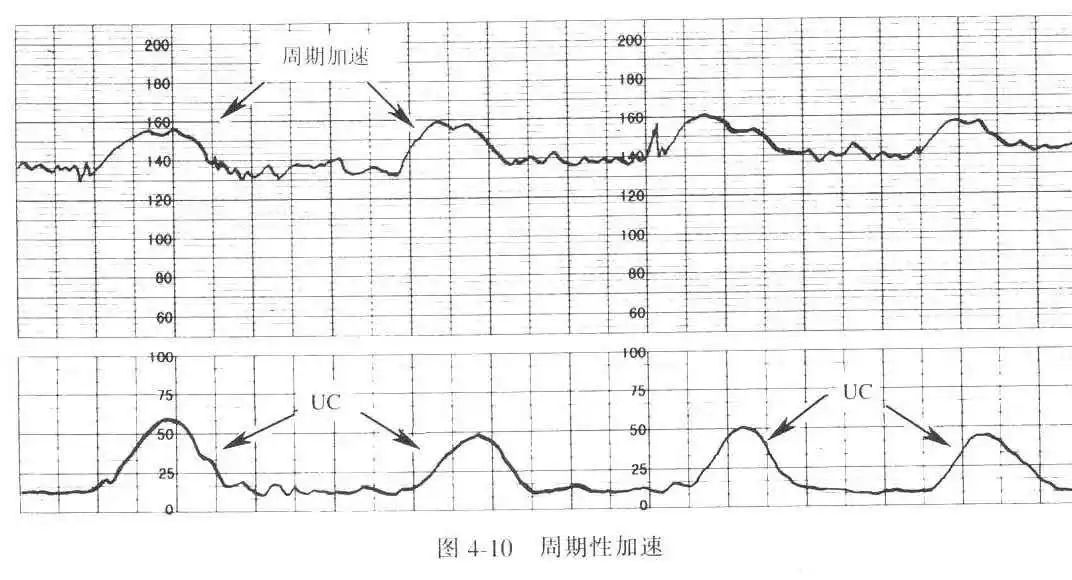 胎心监护图解析图片