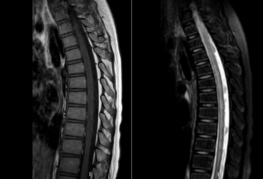 经棘突间入路手术治疗脊髓栓系综合征一例(小儿神经