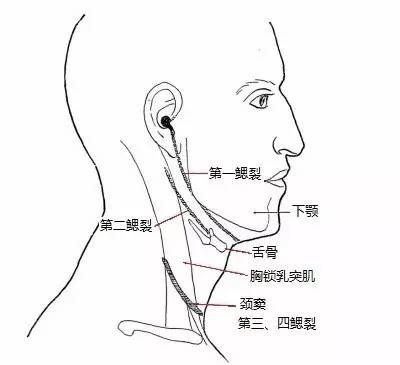 示意图显示不同来源的鳃裂囊肿在颈部的体表位置第 3,4 鳃裂来源:位于