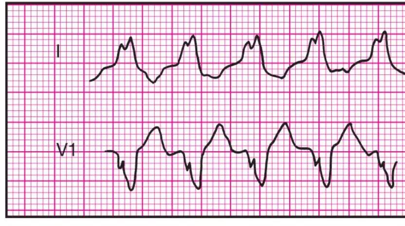 14种异常心电图波形特点收藏