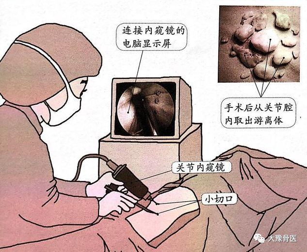 微创关节镜到底是什么?最适合哪些患者?