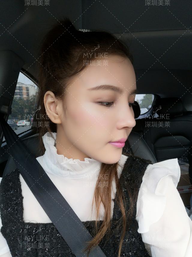 最后,希望爱美的女士都能达成所愿,拥有高挺翘的鼻子.