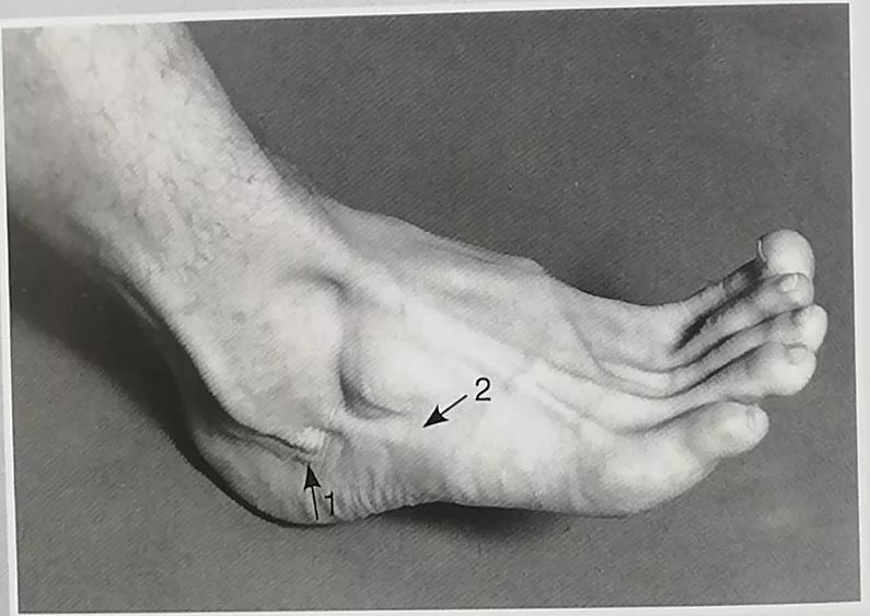 小腿外侧肌群触诊