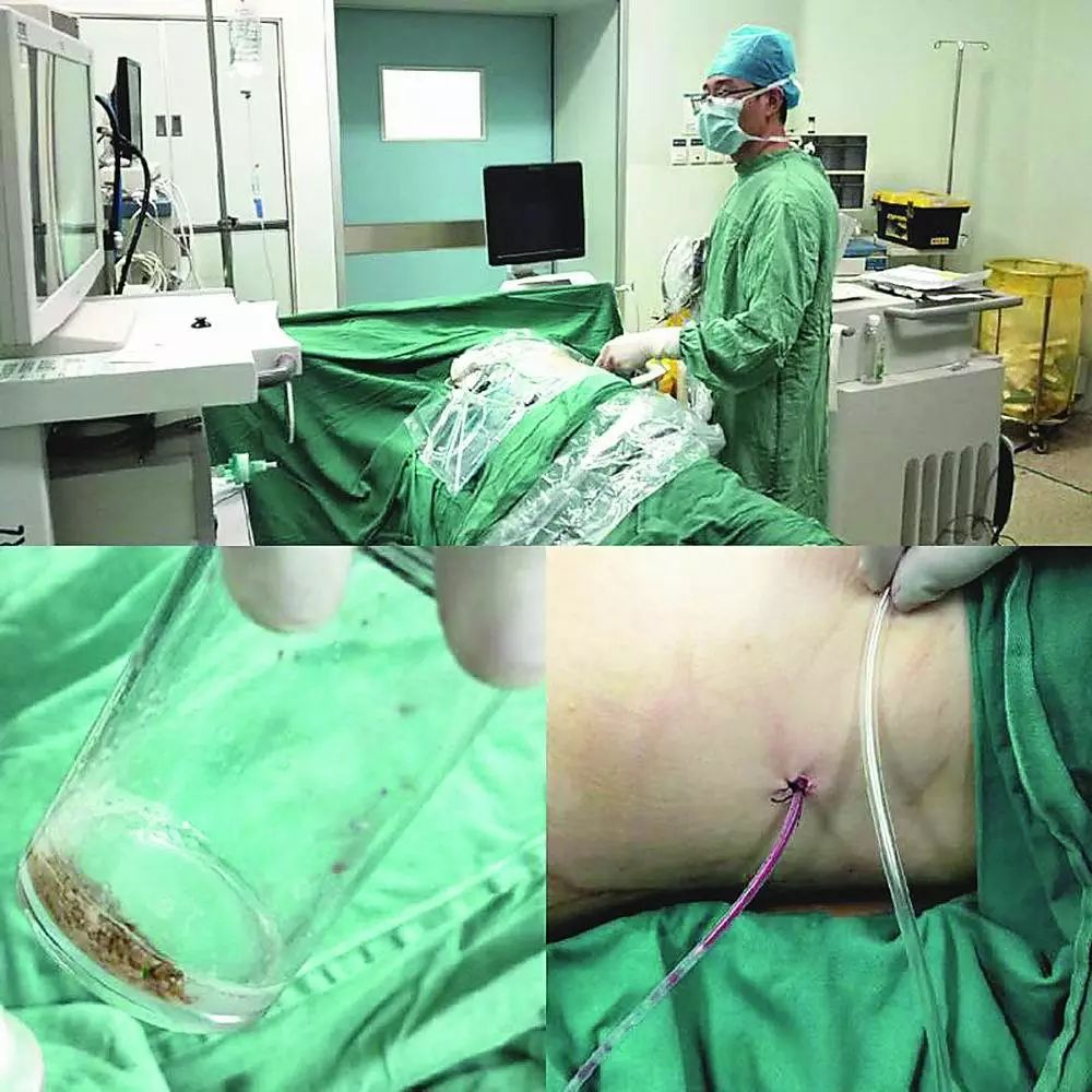 近年来,市人民医院泌尿外科许多传统开放性手术正逐步被微创手术檀