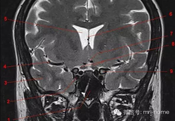 鞍區,垂體磁共振(mri)解剖——冠狀面_動脈