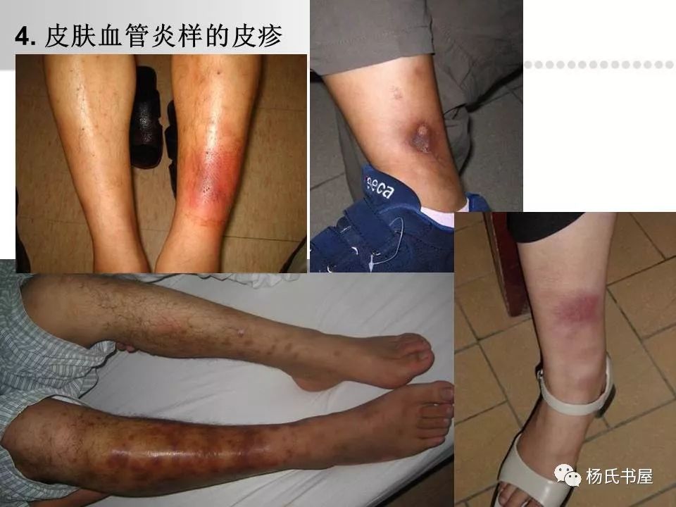 520国际白塞病关爱日一起来了解白塞病