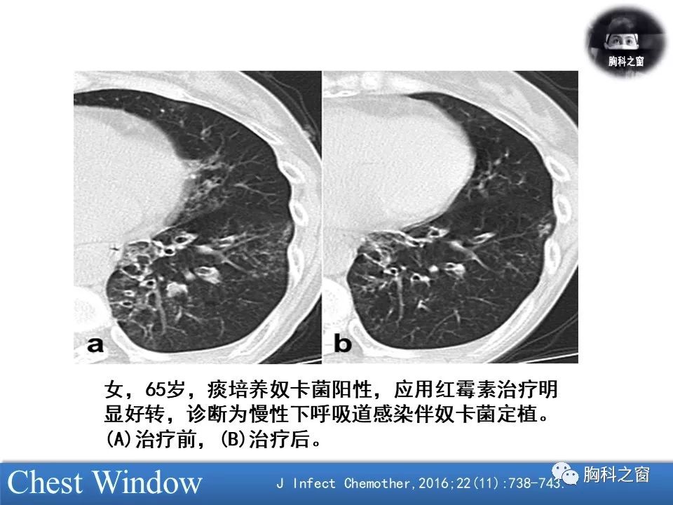 肺奴卡菌病的临床与影像