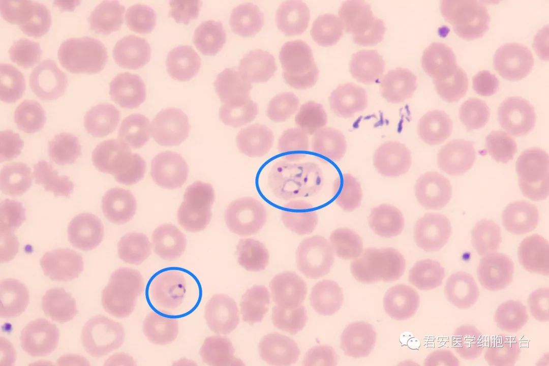 外周薄血膜涂片疟原虫配子体(绿色)(点击小图查看高清大图)6