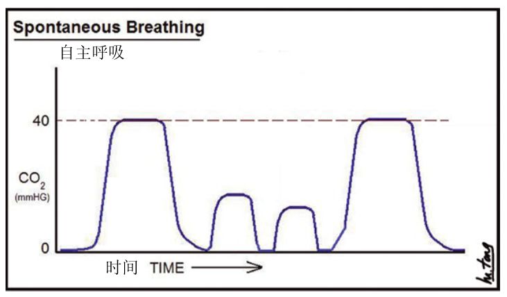 图4,换气过度的二氧化碳波形(图片来自mele tong.