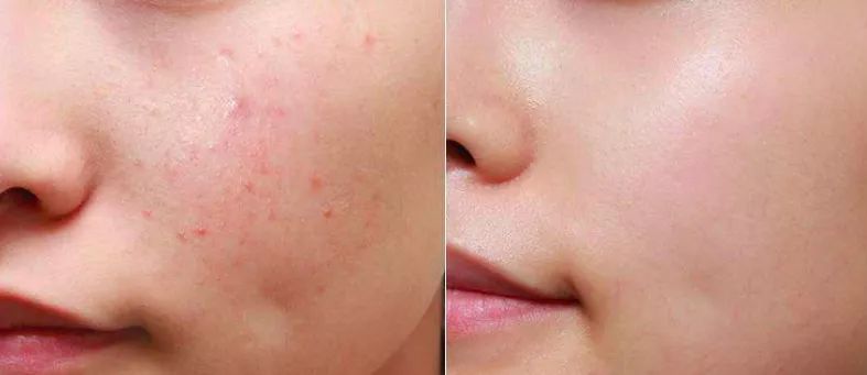 熬夜痘痘肌的救星小编脸很容易晒的红红的,红了以后皮肤就变黑,还有了