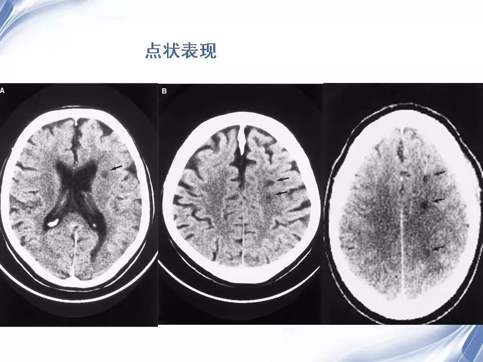 大脑分水岭区图片