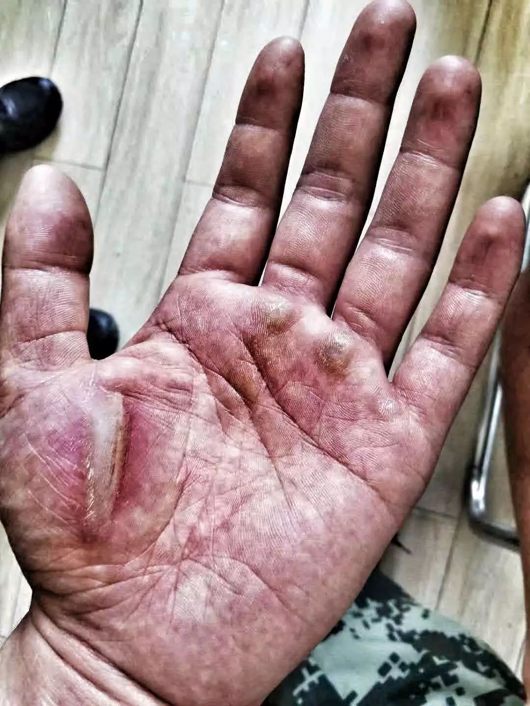抗洪战士受伤的手图片