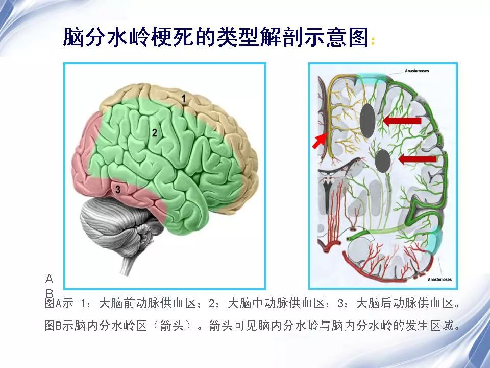 脑分水岭梗死影像天地