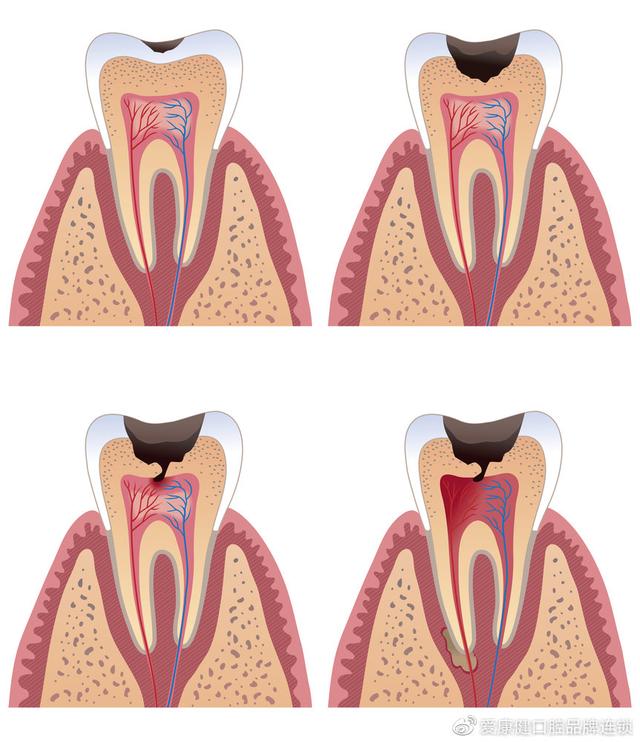 蛀牙分為4個階段,有淺齲,中齲,深齲,而牙根壞死就是深齲的症狀