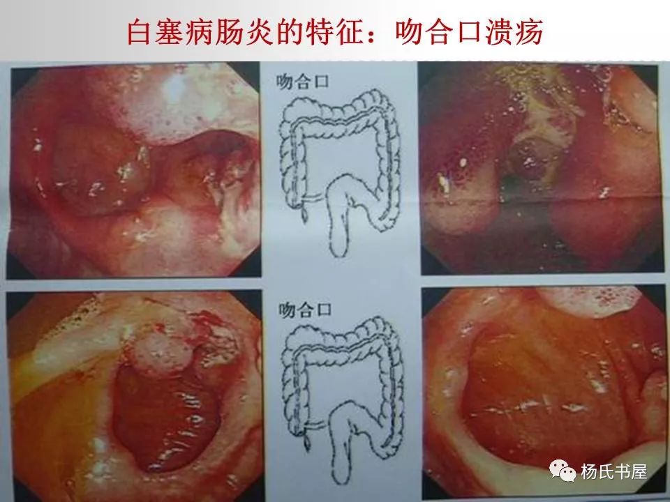 520国际白塞病关爱日一起来了解白塞病