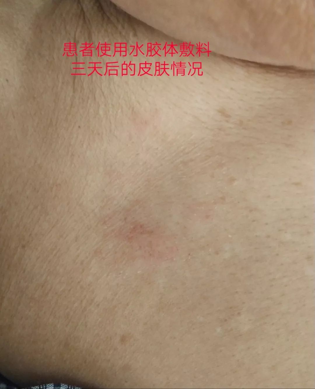 电极片过敏致皮肤破溃,这样改良实特高明,一箭双雕!