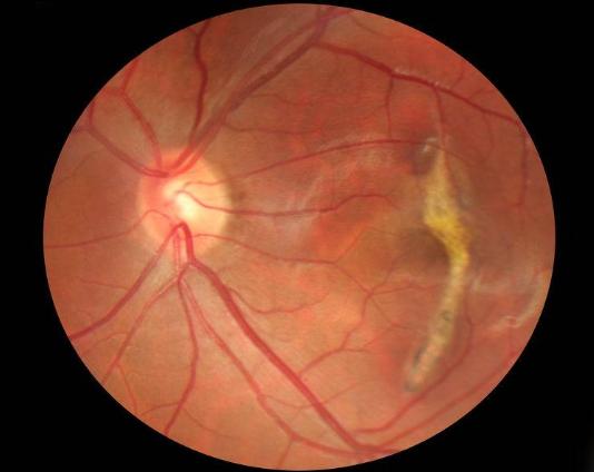 眼睛出现"飞蚊症"不容小觑,可能会造成视网膜剥离,别大意