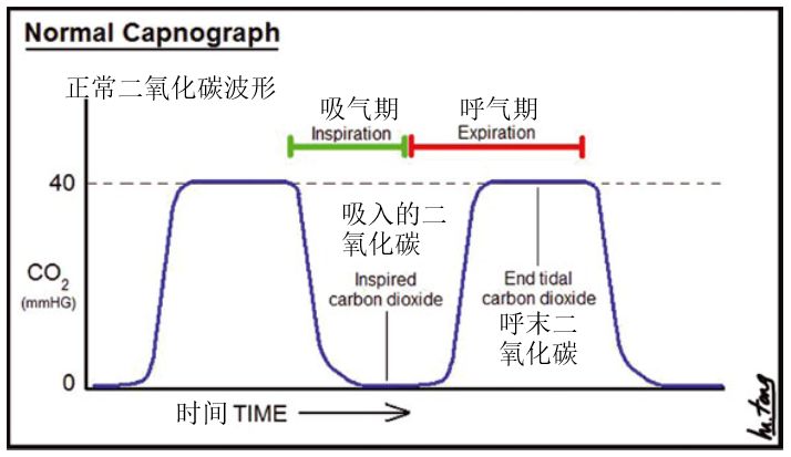 345678图3,通气不足的二氧化碳波形(图片来自mele tong.