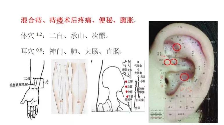 皮内针(揿针)疗法在全科中的应用