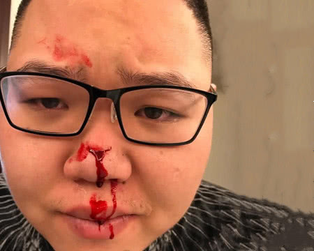 pdd惨遭胖揍脸上被人打了一拳网友要我忍不了