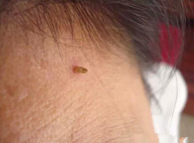 你脖子上长小肉粒了没