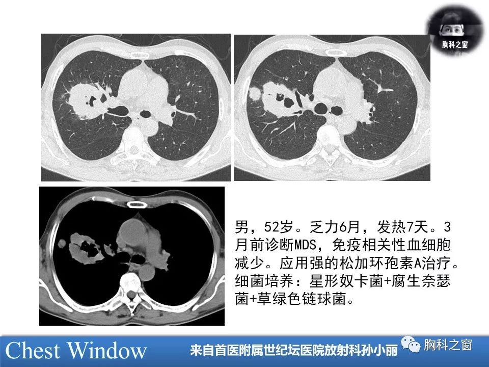 肺奴卡菌病的临床与影像
