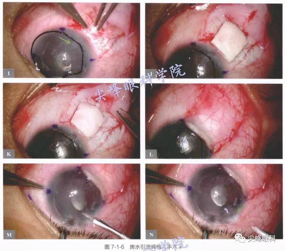 房水引流阀植入手术之手术操作part03图解青光眼手术操作与技巧049