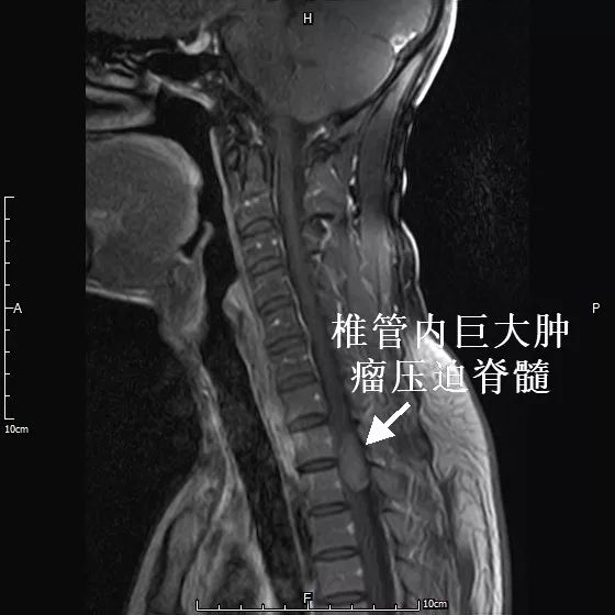胸椎脊膜瘤图片