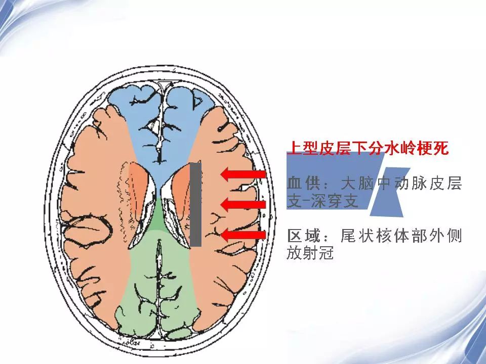 大脑分水岭区图片