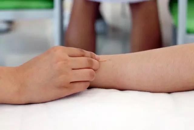 腕踝针北京大学第三医院延安分院(延安市中医医院)康复科现开展特色