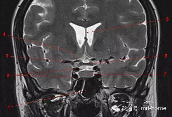 鞍区解剖图MRI图片