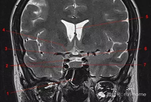 鞍区垂体磁共振mri解剖冠状面