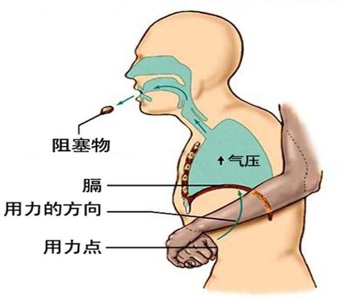 急救气道异物梗阻之普通人群