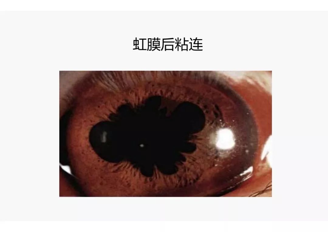 眼睛是风湿的窗户葡萄膜炎的诊断和治疗策略
