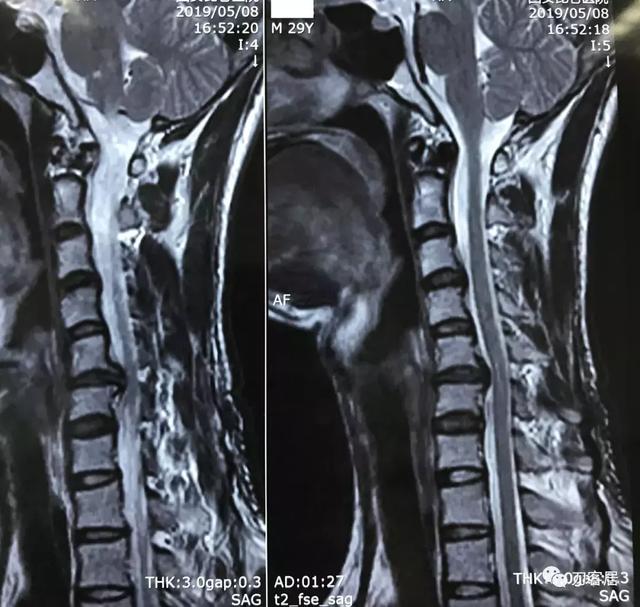 2019年5月8日所拍攝磁共振片顯示的頸椎曲度以及突出椎間盤均較2018年