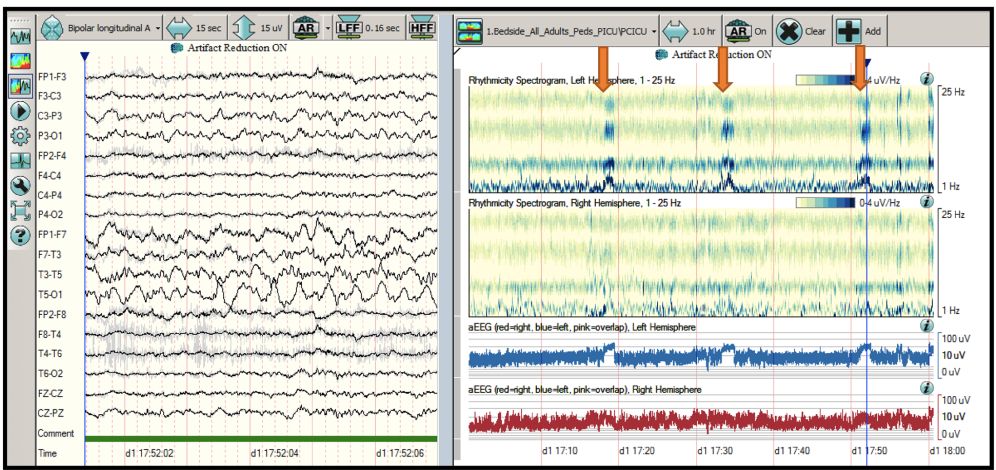 定量脑电图可实时识别icu患者的癫痫发作