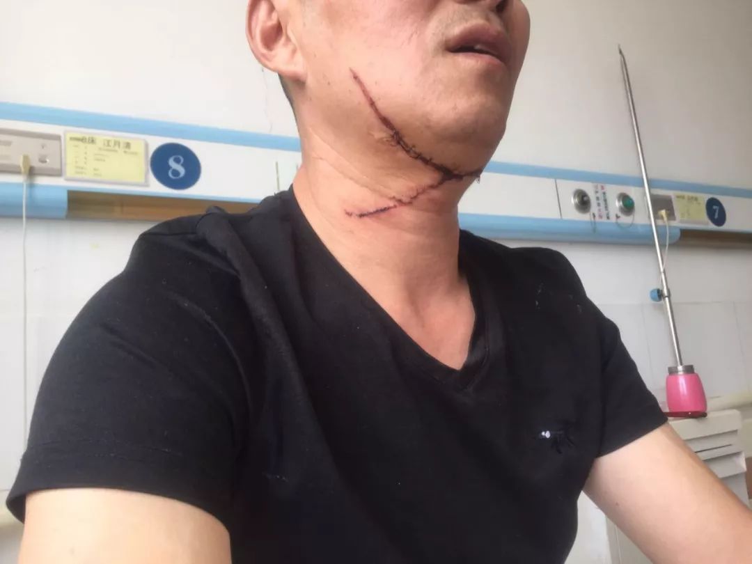 淮安男子喉咙被割,伤口30厘米,缝了14针!