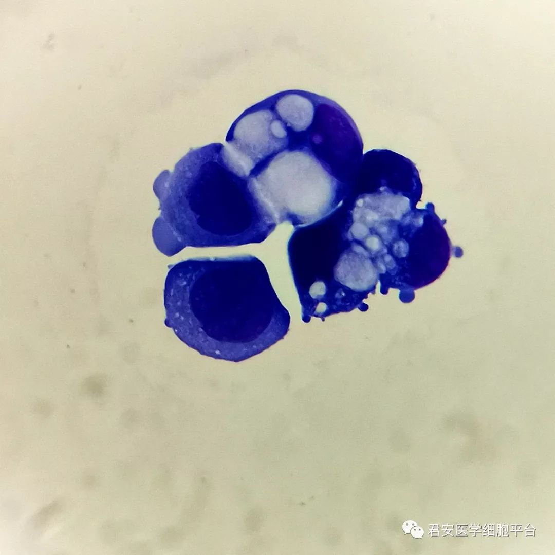 一张腹水涂片的大作用_细胞