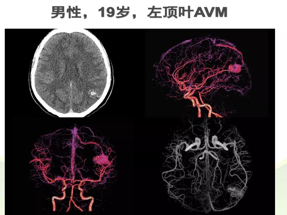 先天性脑血管畸形图片图片