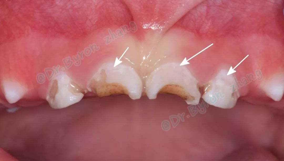 儿童牙齿钙化早期图片图片