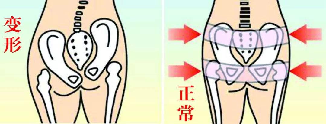 儿童骨盆倾斜图片