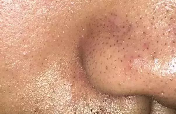 1分钟搞定20年的草莓鼻?黑头收割机,一键清零毛孔,超滑嫩!