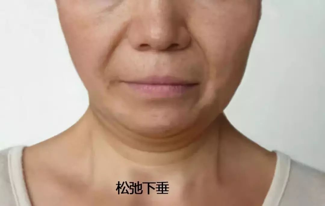 在小品中说的那个拉皮还能刺激真皮层产生atp,合成胶原蛋白紧致肌肤