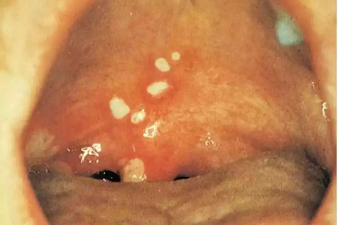 相同处:疱疹性咽峡炎和手足口感染后,口腔的咽部和软腭都会长疱疹.1.