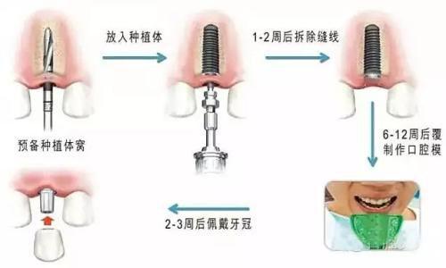 烤瓷牙安装过程图片