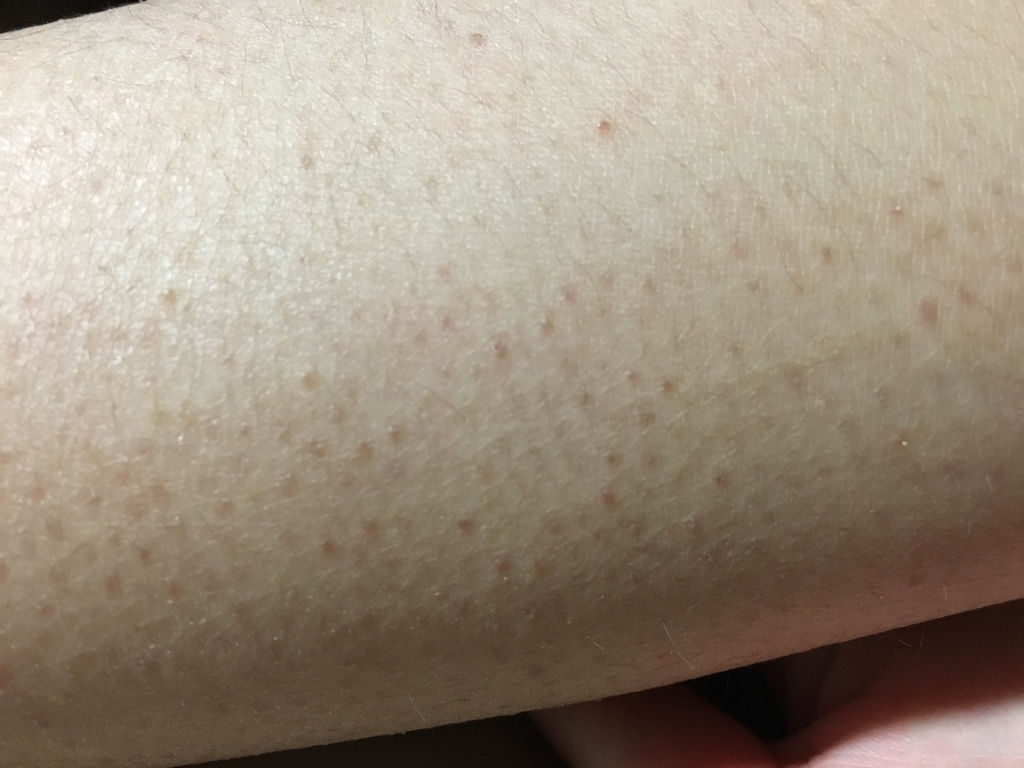 "鸡皮肤"和什么有关?看这里,4方法3注意,还你光滑美肌!