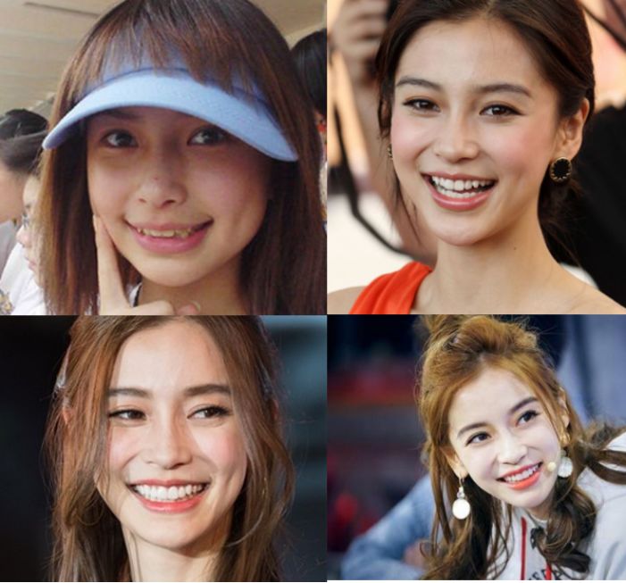 ab从最初的凸嘴牙套妹到现在的少女风,ab整体形象提升,也离不开整牙的