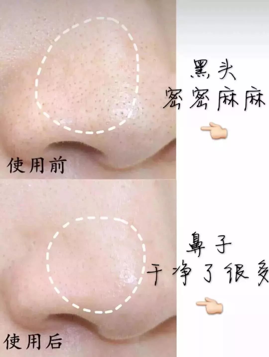 1分钟搞定20年的草莓鼻?黑头收割机,一键清零毛孔,超滑嫩!