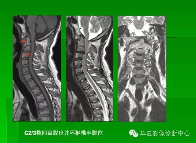工作必备椎间盘的突出膨出脱出髓核游离的鉴别
