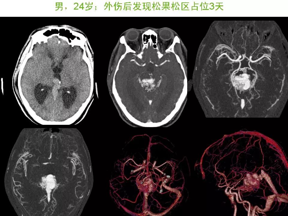 脑血管畸形的影像诊断 影像天地